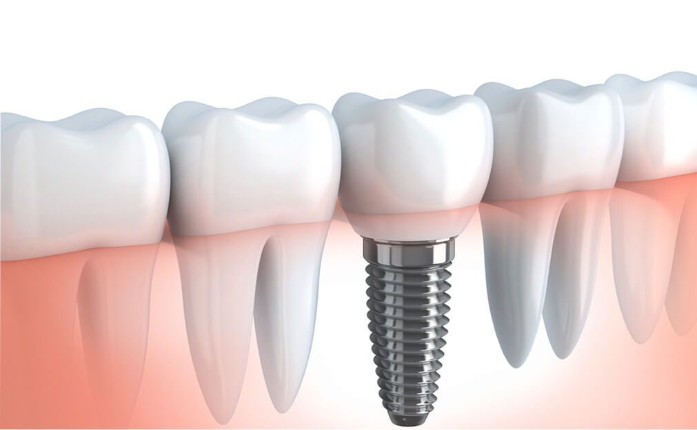 oral surgery and dental implants chappaqua ny