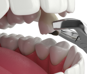 Tooth Extractions in Westchester NY