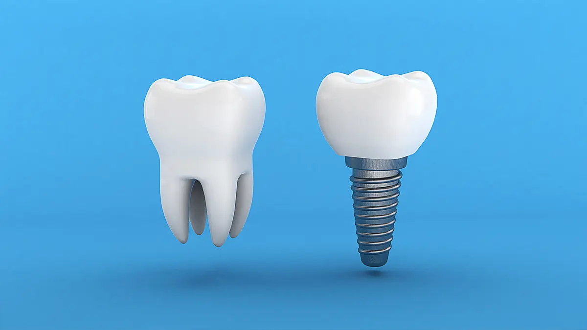 How Long Do Tooth Implants Last