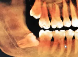 Xray of an impacted wisdom tooth that needs to be removed
