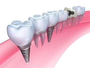 An illustration of dental implants and how they look when implanted in a jaw