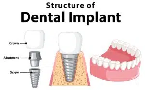 Dental Implants in Westchester County