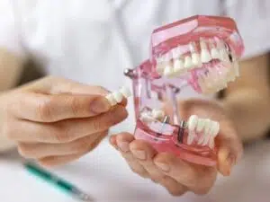 Tooth Implants vs. Dental Bridges