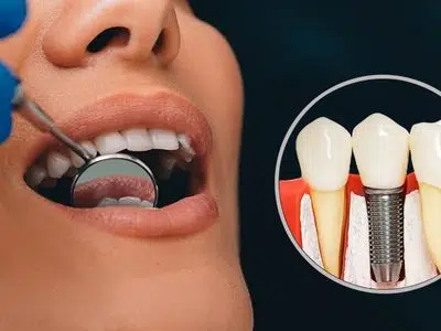 Tooth Implants vs. Dental Bridges