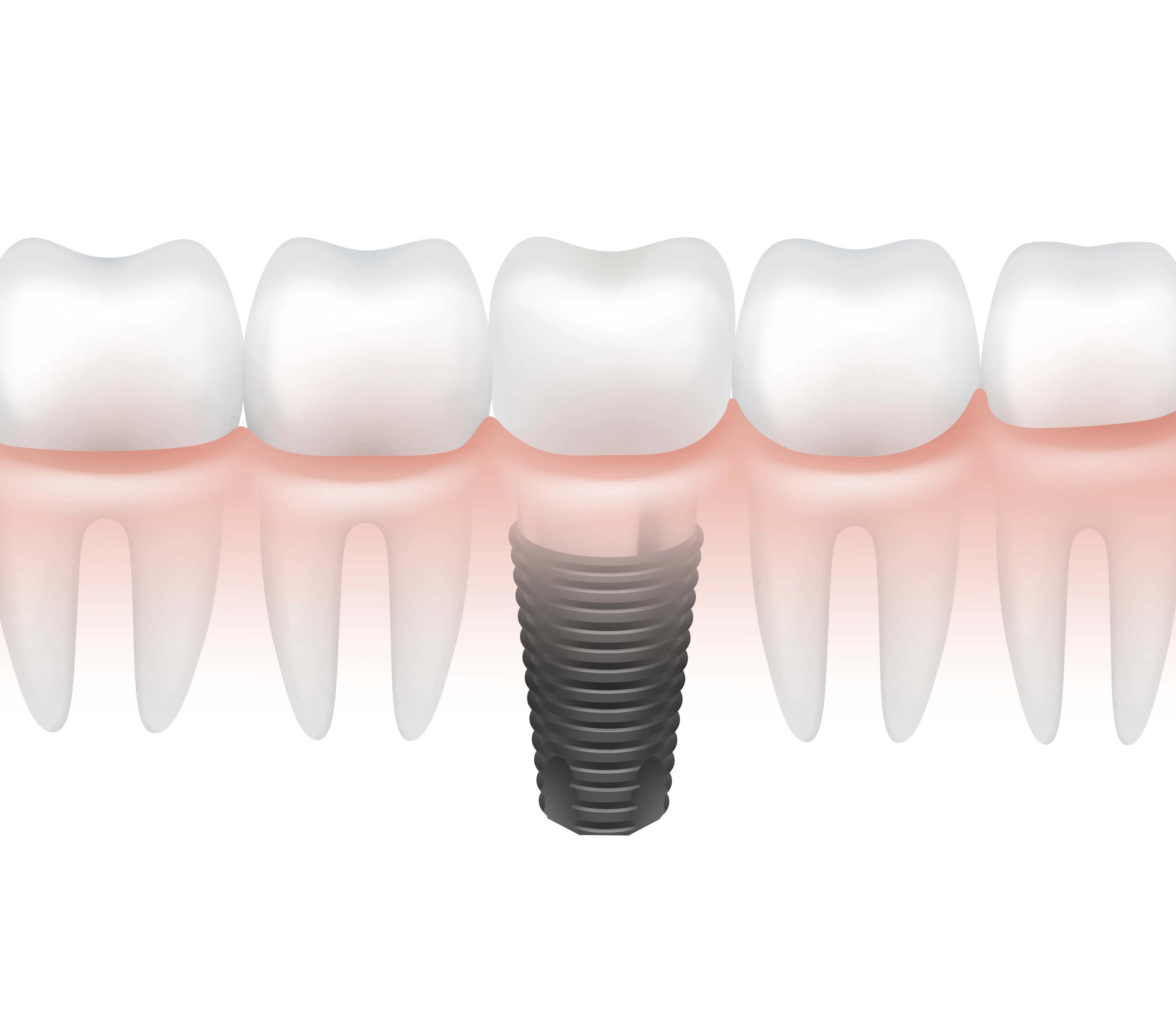 Implant Dentistry in Westchester NY