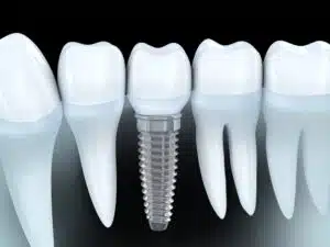 benefits of dental implants