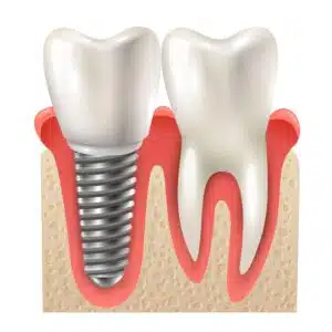 Benefits of Dental Implants