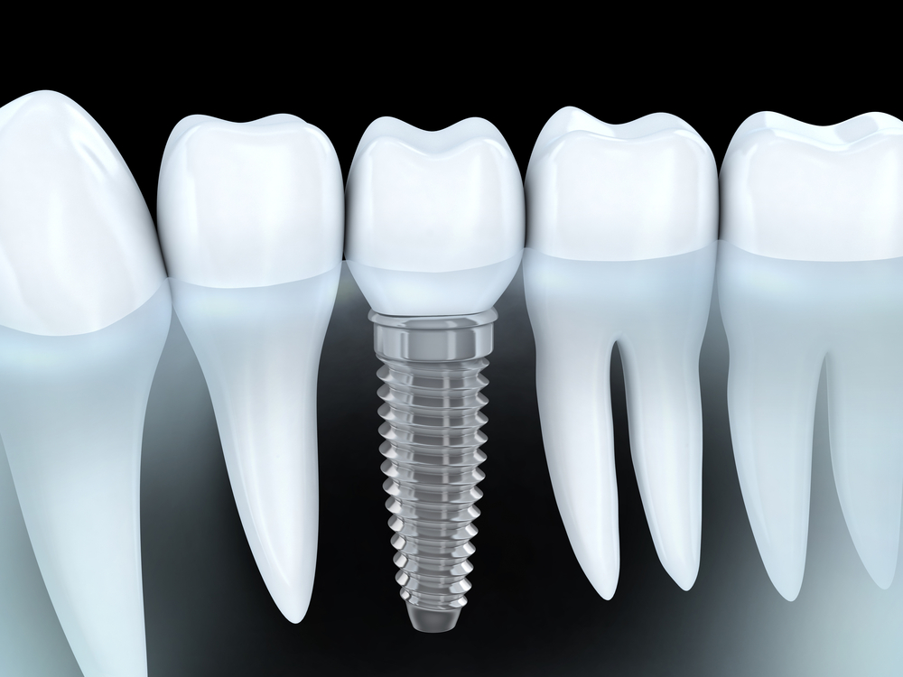 dental implants Yorktown Heights NY