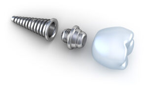 dental implants