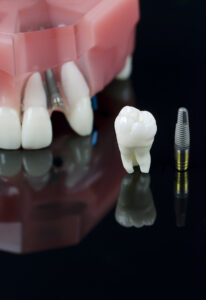 dental implants