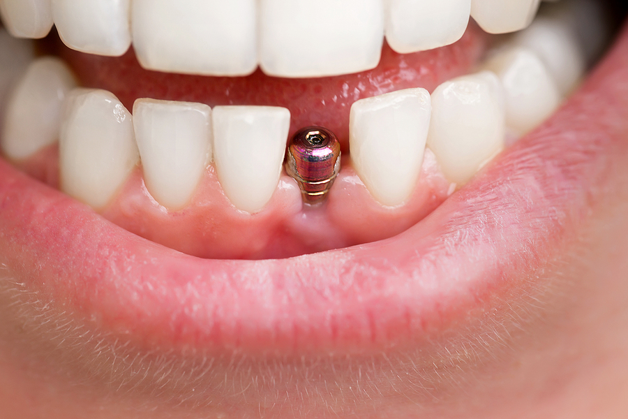 dental implants