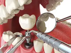 Dental Implants Westchester County