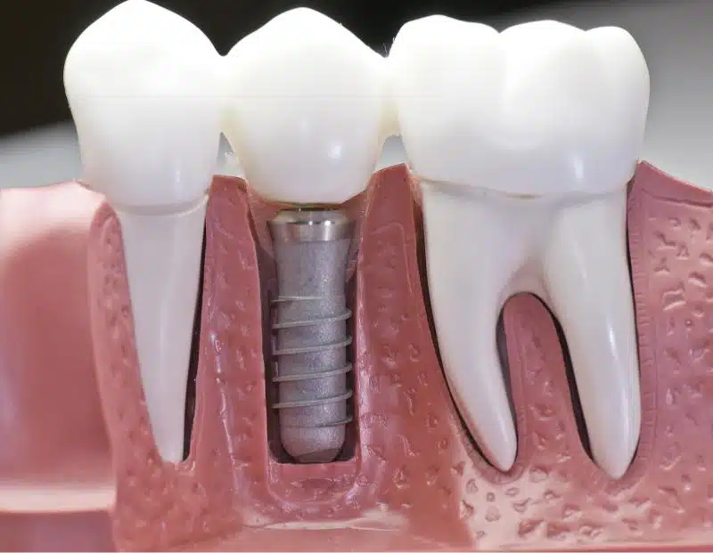 Guide to Dental Implants: A Comprehensive Patient Resource