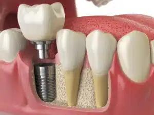 Care for Your Dental Implants: Best Habits for Lasting Oral Health